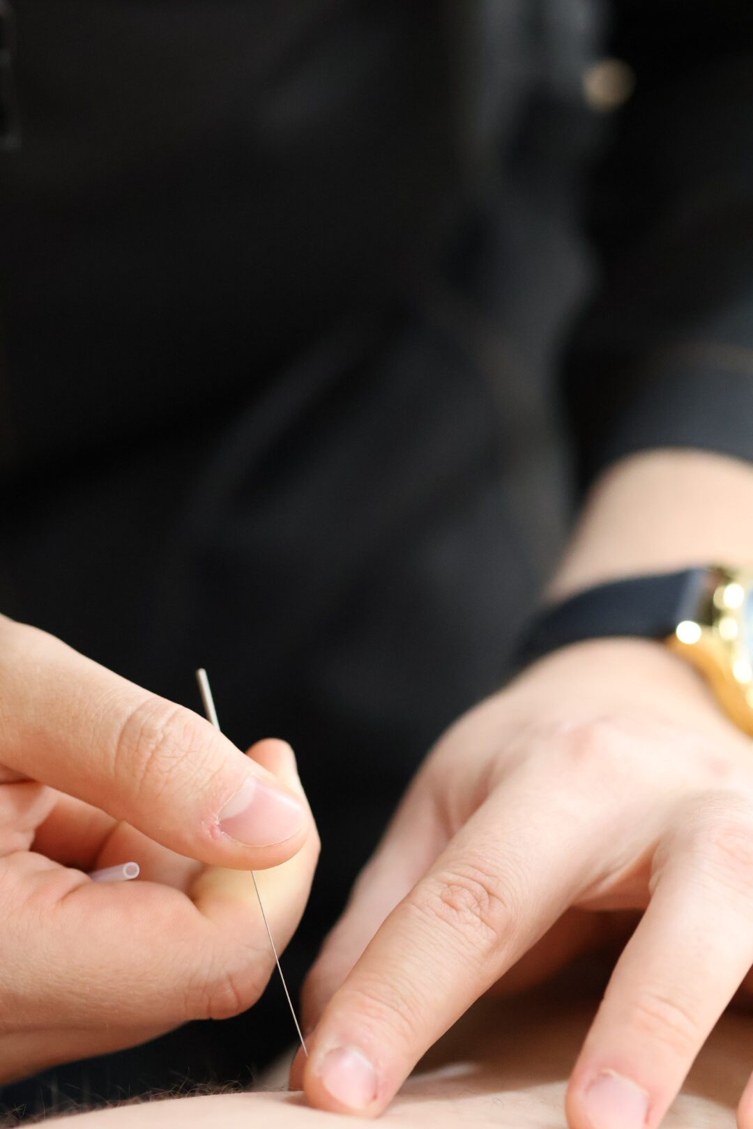 Aplicação de agulhamento a seco (dry needling) na musculatura do ombro